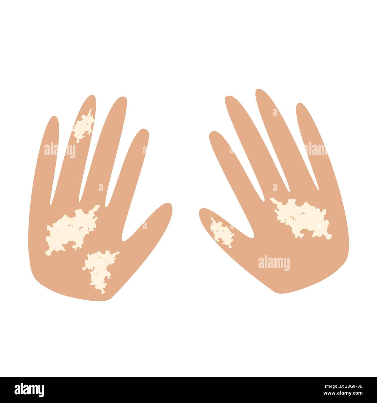 Vitiligo en las manos. Manchas blancas en la piel de las manos. Infografías  ilustración vectorial Imagen Vector de stock - Alamy