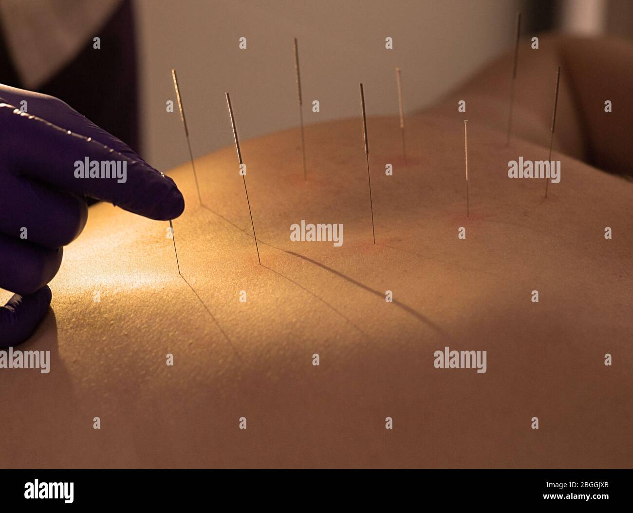 Acupuntor insertando una aguja en la espalda femenina. paciente con tratamiento tradicional china usando agujas para restaurar un flujo de energía a través de spec Foto de stock