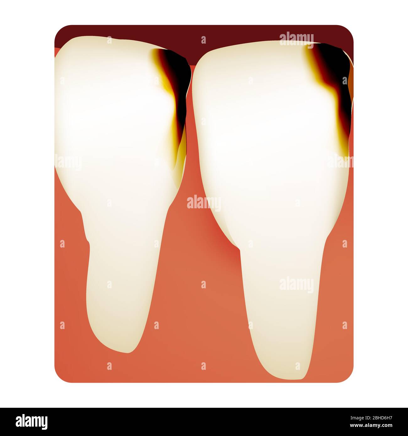 Caries dental. Caries dental. Infografías de caries. Ilustración