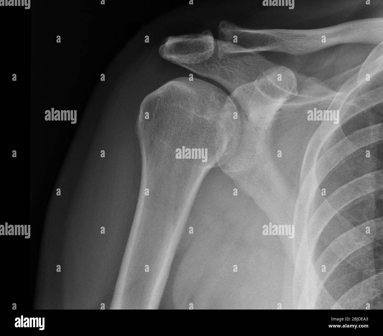 Radiografía de hombro que muestra el estado de la lesión