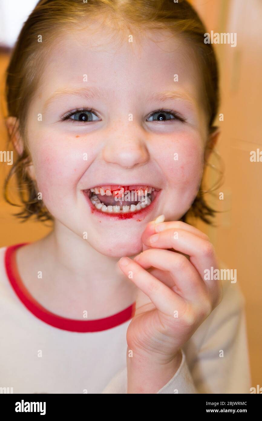 Una niña de cinco años de edad que está feliz y encantada, habiendo sacado uno de sus dientes de leche, un incisivo de la parte superior suelta. La herida sangra con sangre por un momento después. (119) REINO UNIDO Foto de stock