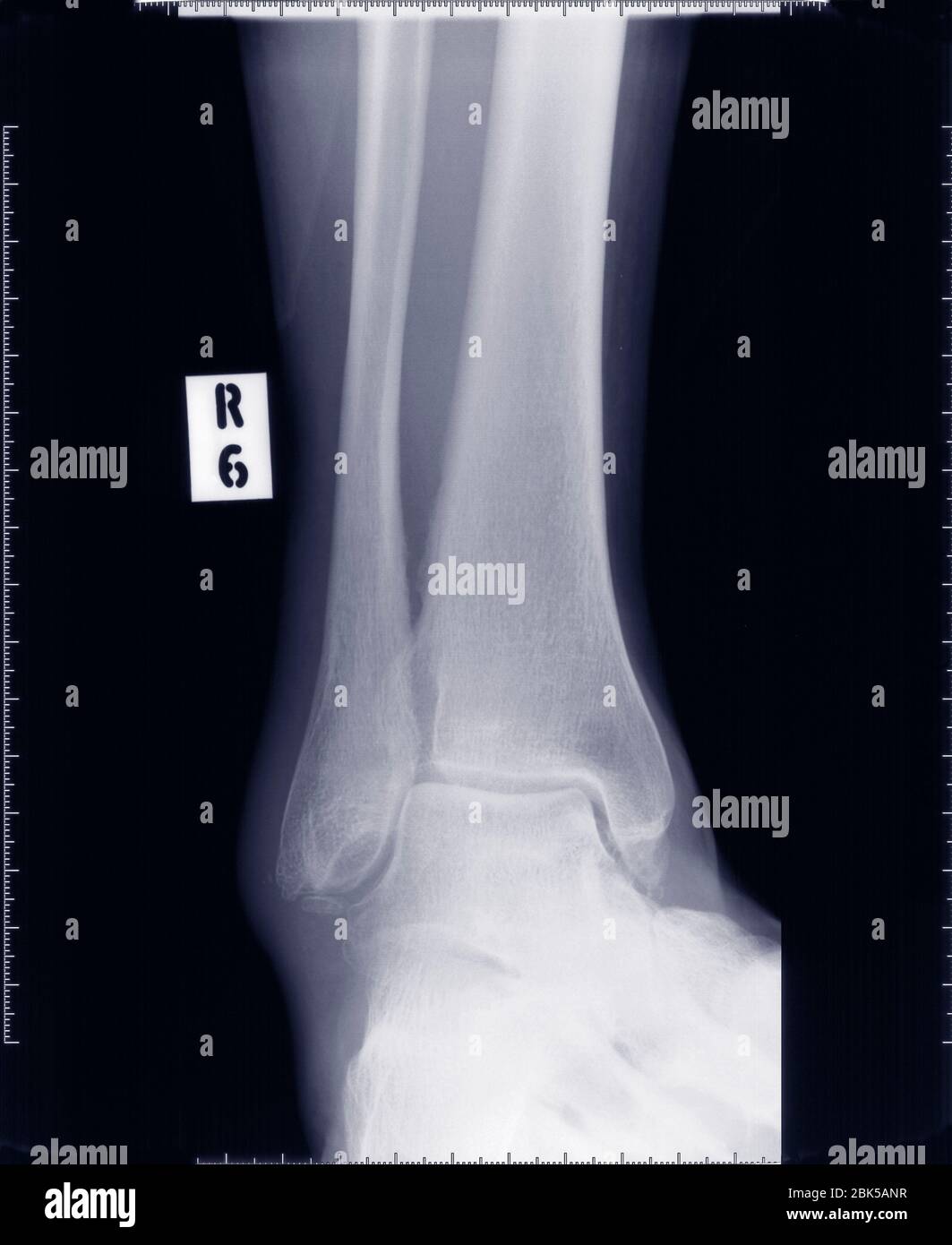 Articulación del tobillo, radiografía. Foto de stock
