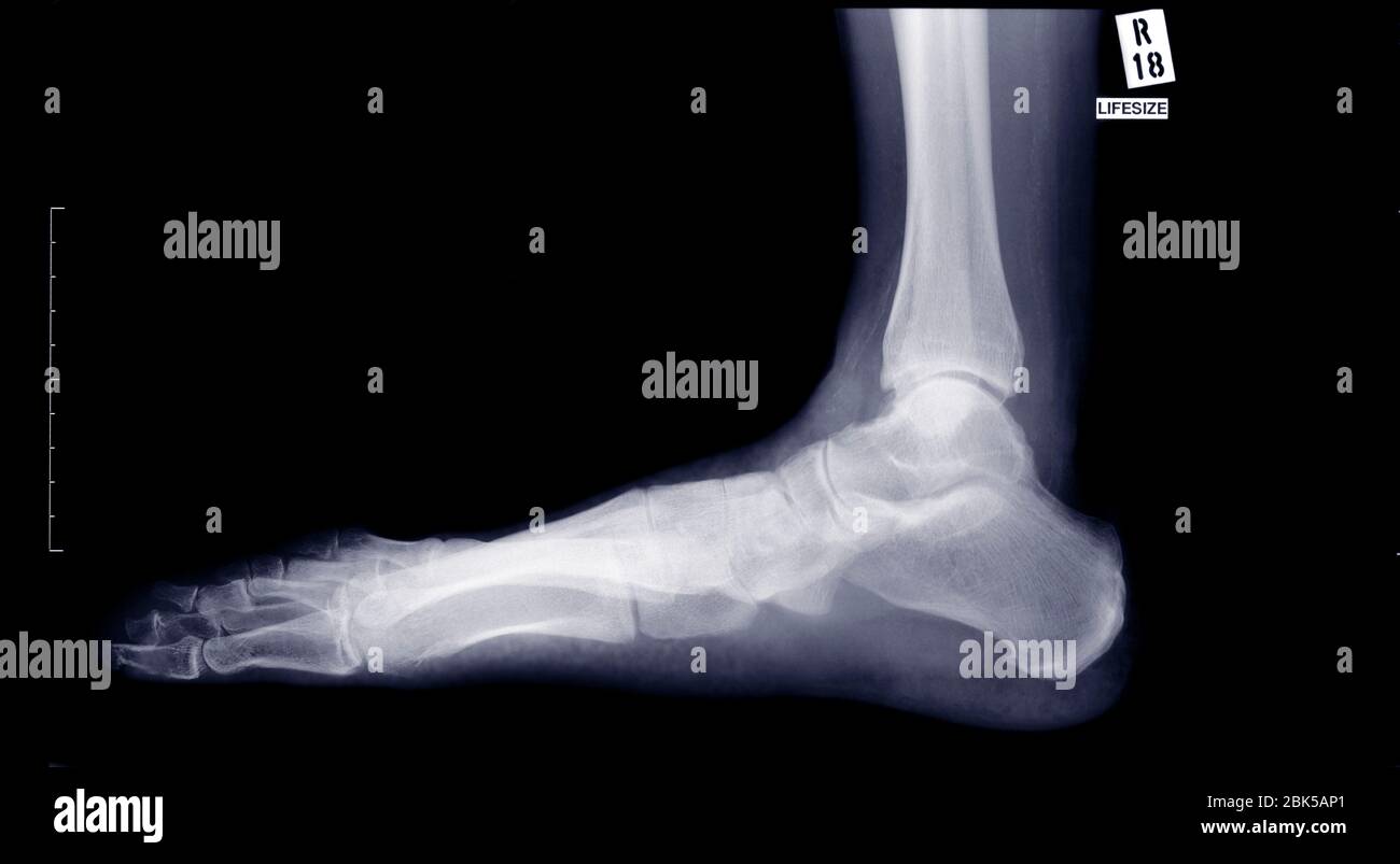 Pie y tobillo, rayos X. Foto de stock