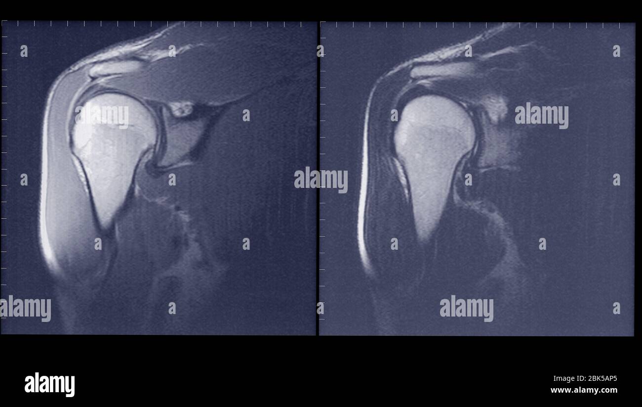Articulación del hombro, IRM. Foto de stock