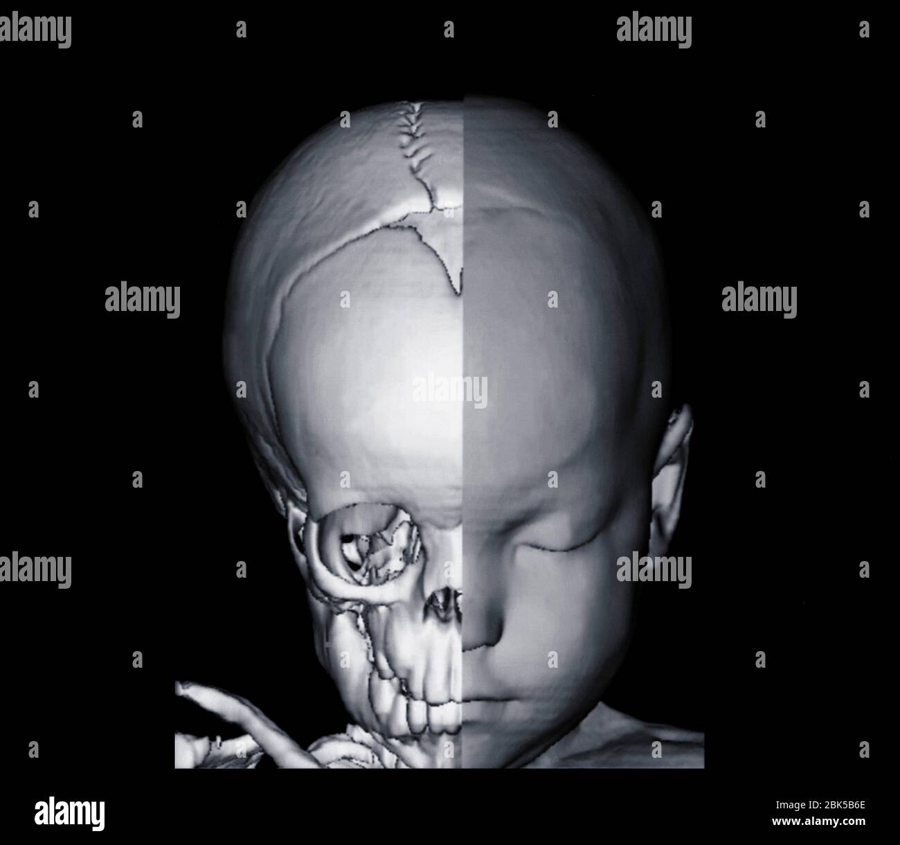 Imagen de la cabeza y medio cráneo del bebé, tomografía computarizada (TC). Foto de stock