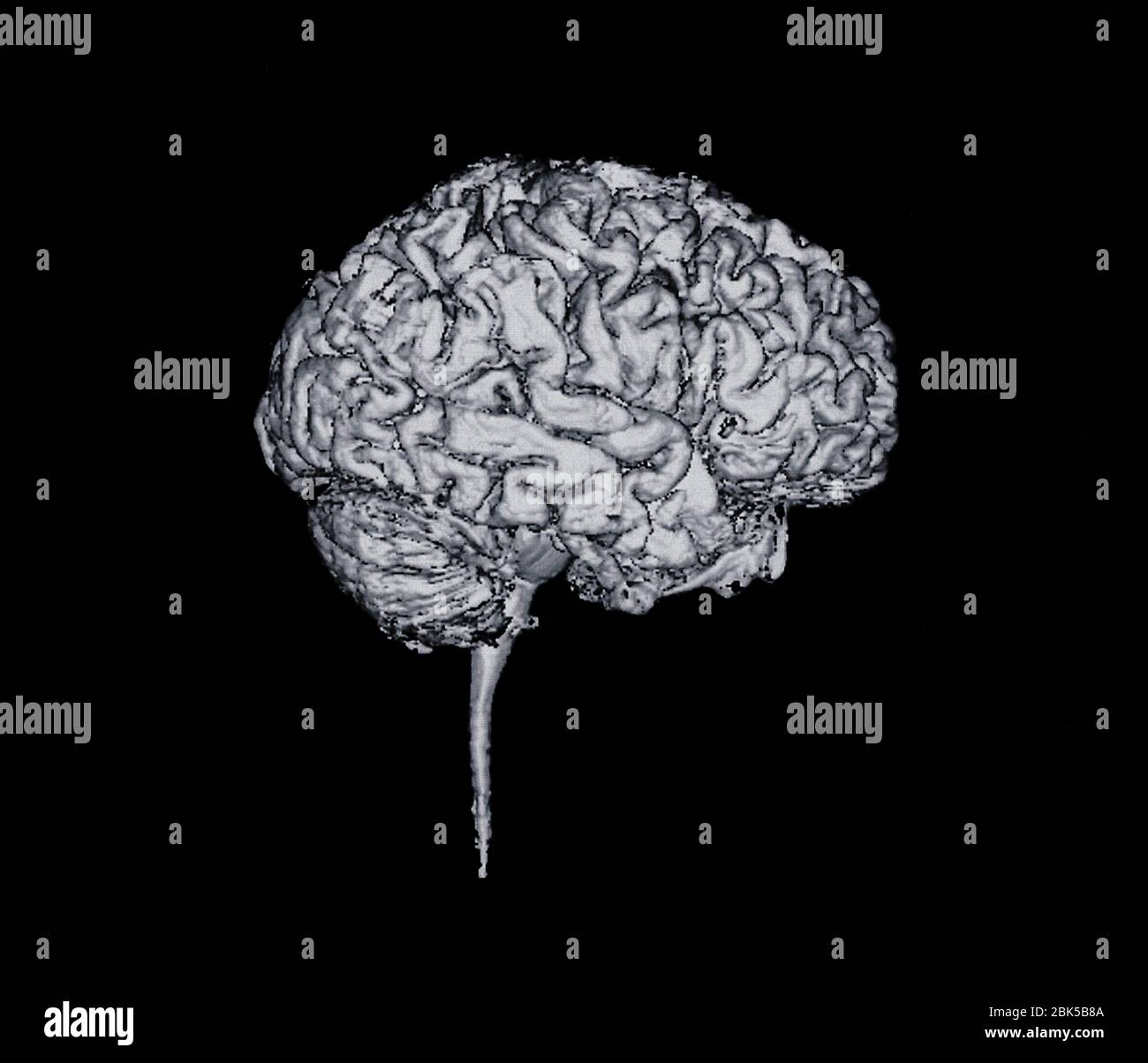 Vista lateral del cerebro, rayos X. Foto de stock