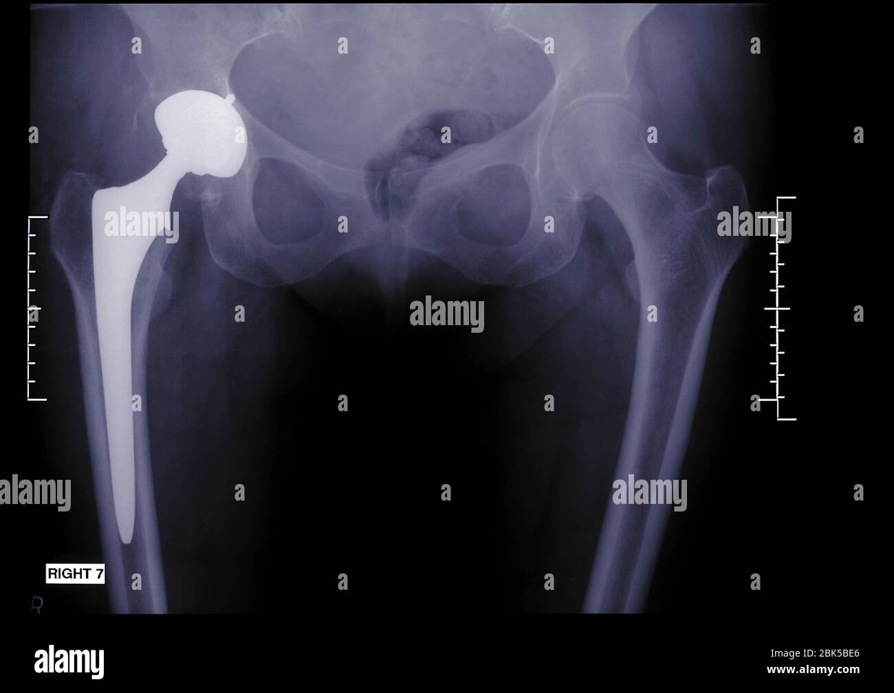 Persona con una cadera artificial, radiografía. Foto de stock