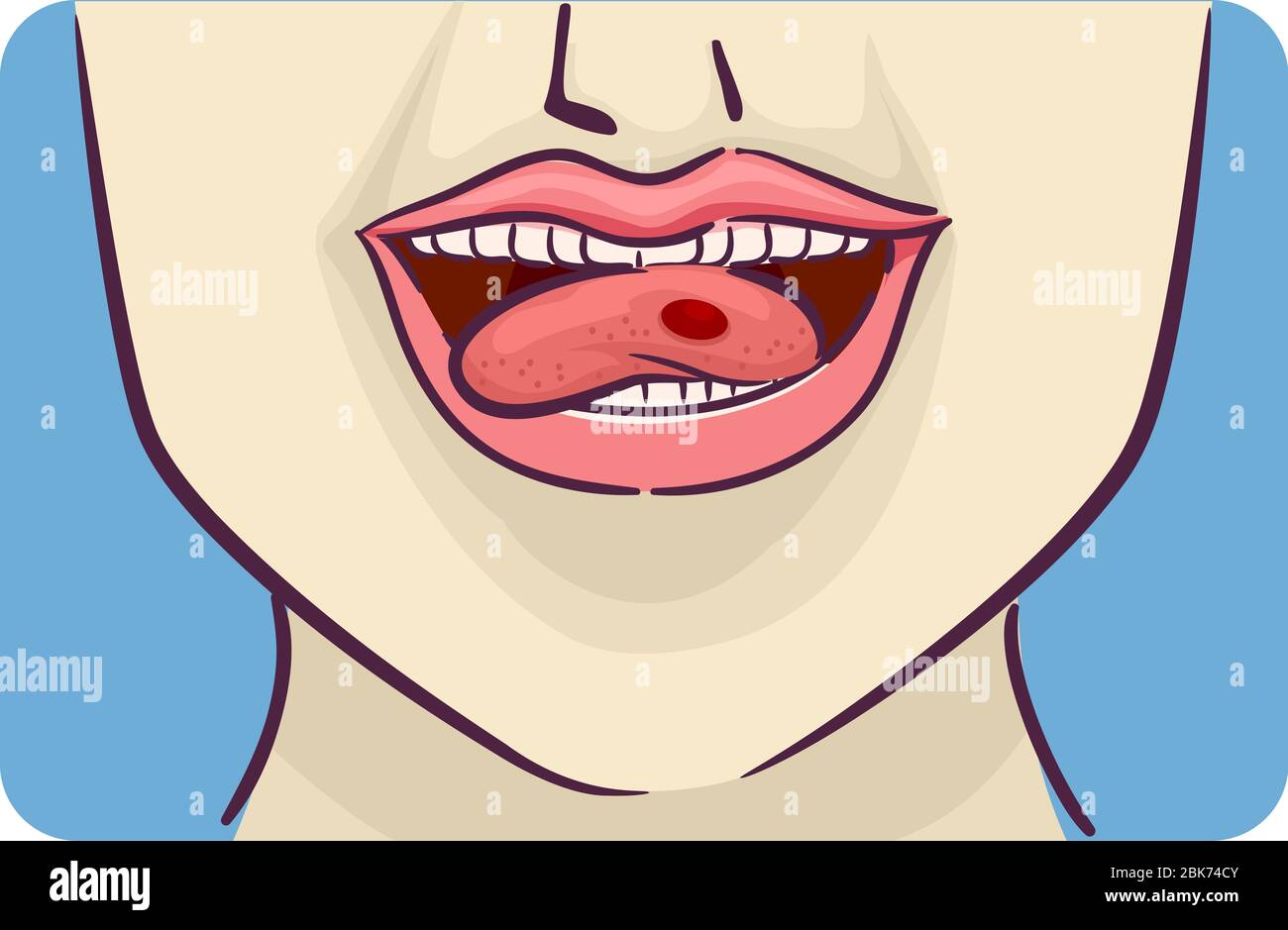 Ilustración de la boca con blíster de sangre roja en el lado de la