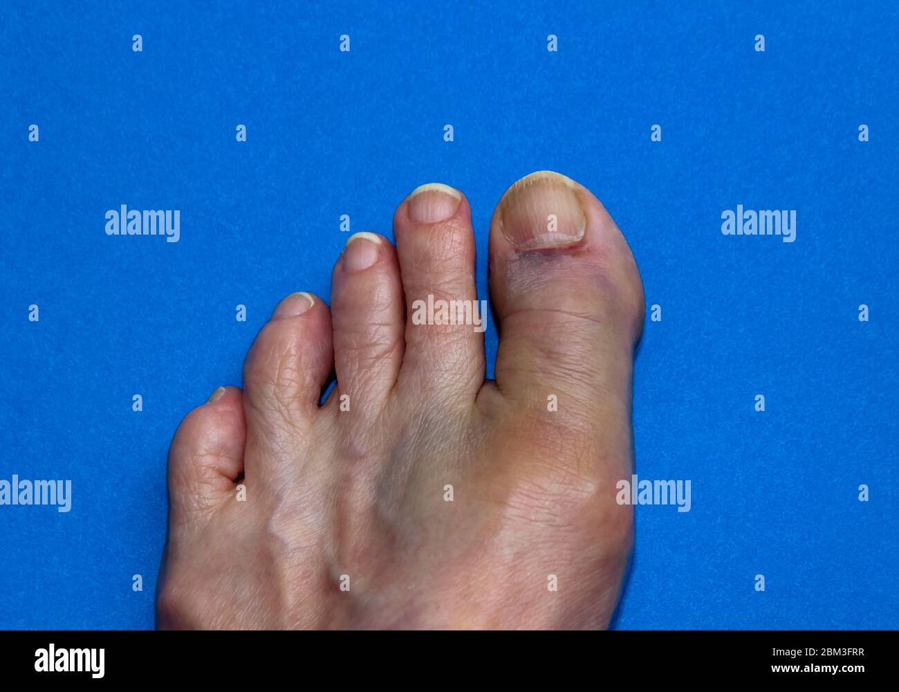 Dedo gordo del pie roto (fracturado). Foto de stock