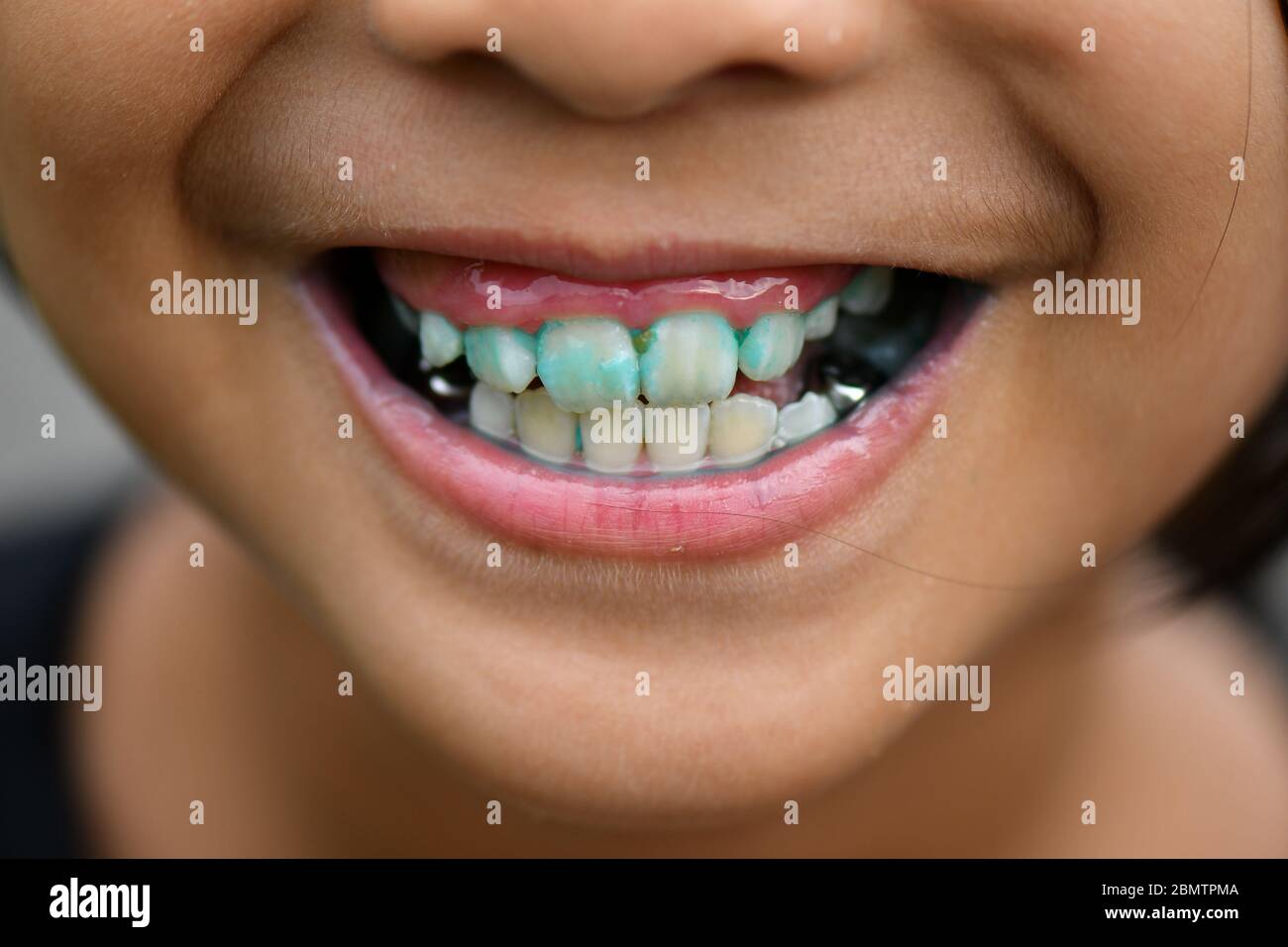 niño mal dental con corona Foto de stock