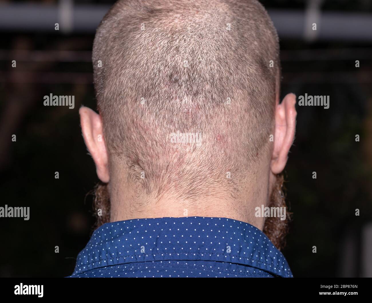 Vista posterior de un hombre calvo que sufre de acné del cuero cabelludo,  puntos rojos picantes en la parte posterior de la cabeza Fotografía de  stock - Alamy
