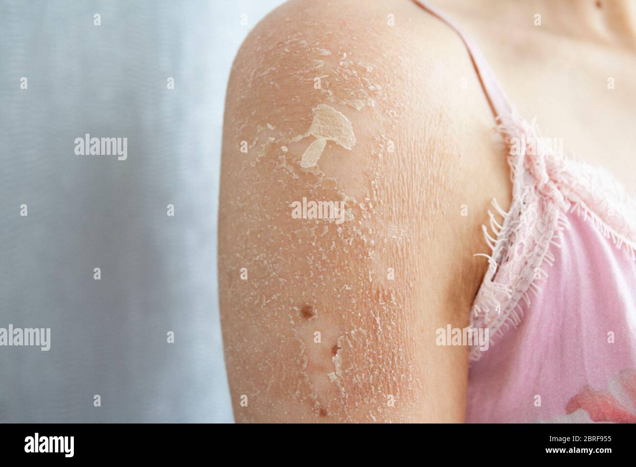 Primer plano de Eczema (Dermatitis), Alergia, Psoriasis, hongos, piel