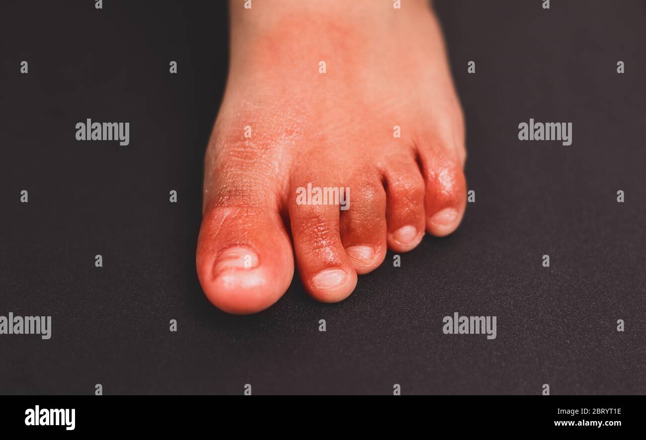 Inflamación roja dolorosa en el dedo del pie llamada lesiones del dedo gordo del pie signo extraño de nuevos síntomas o infecciones del coronavirus Foto de stock