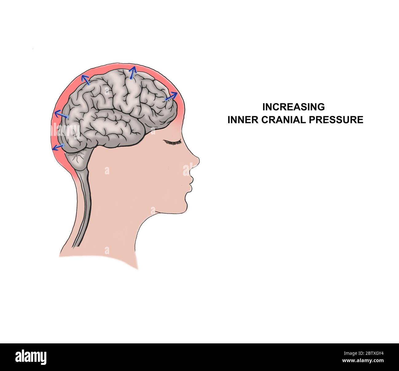 Ilustración médica del aumento de la presión craneal interna Foto de stock