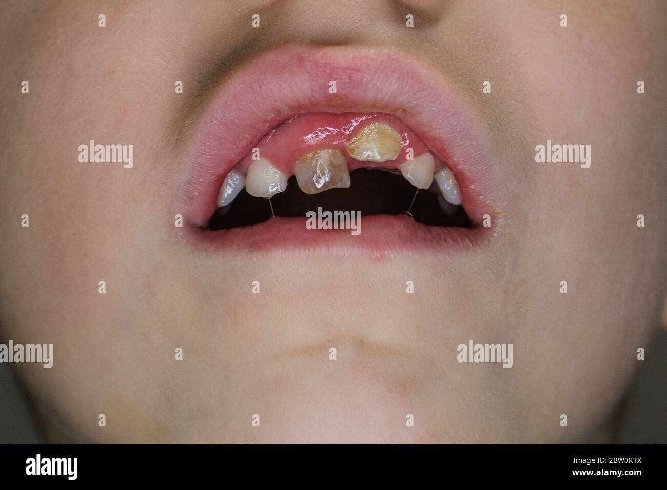 Boca de niño pequeño, dientes torcidos caries, cuidado de la salud infantil Foto de stock