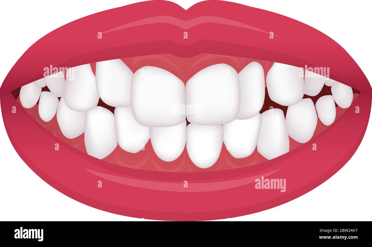 Problemas De Dientes Tipo De Mordedura Dientes Torcidos 