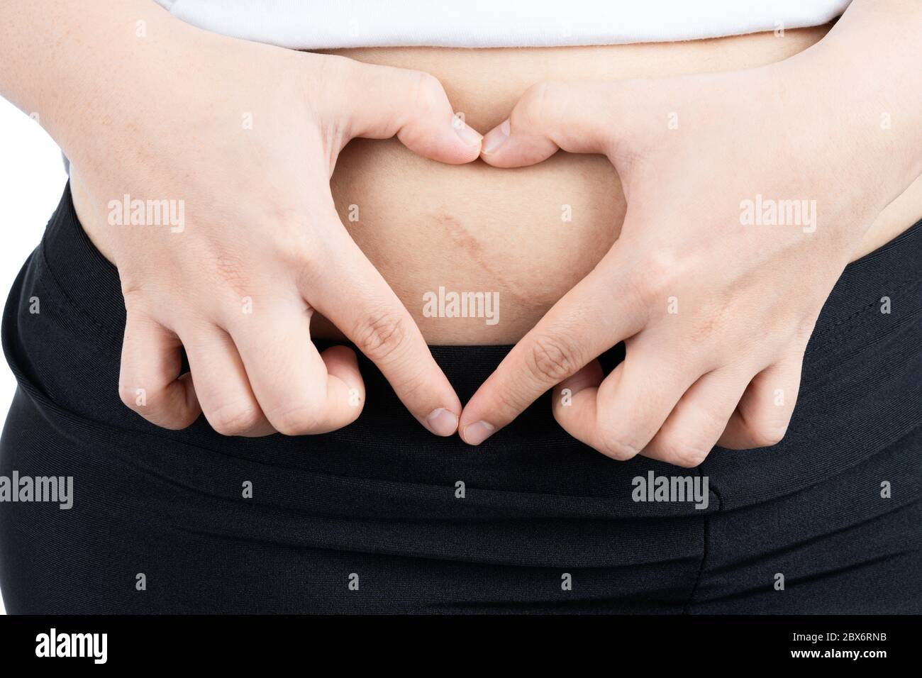 Cicatriz de apendicitis fotografías e imágenes