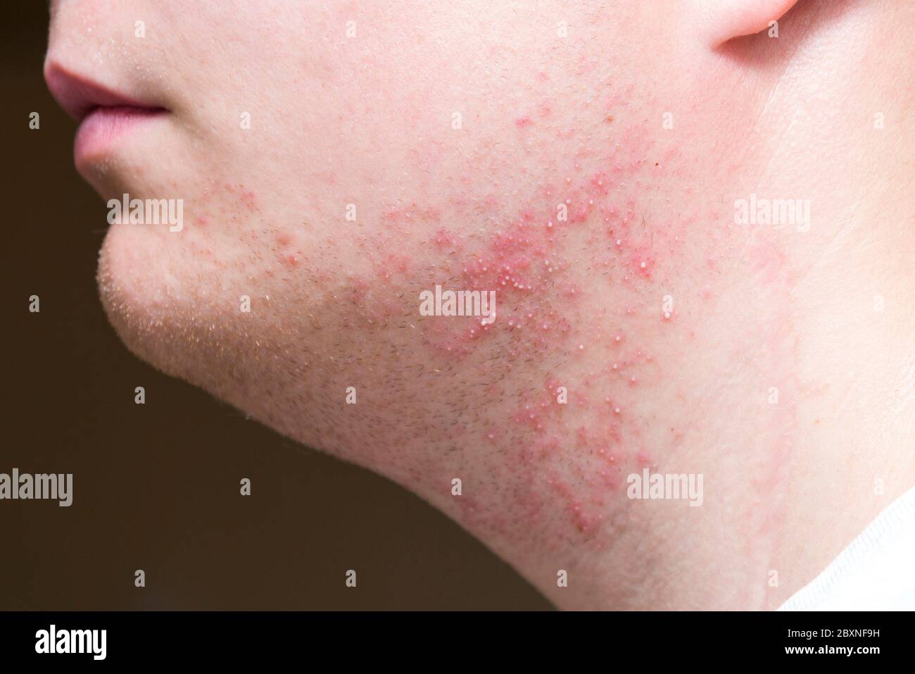 Irritación severa después de afeitarse en el cuello de un hombre, primer  plano Fotografía de stock - Alamy