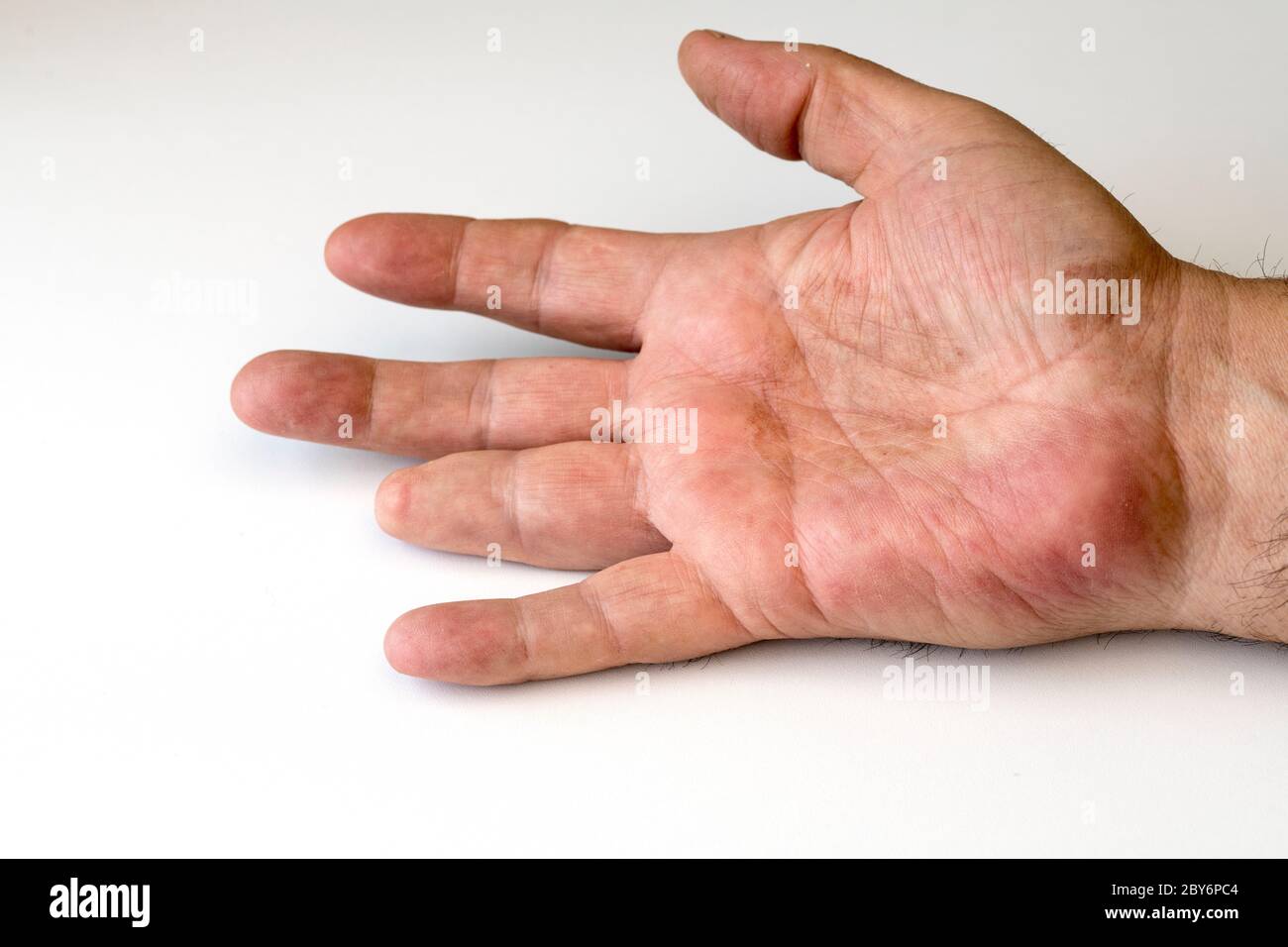 Amputación superior del tercer dedo.accidente de mano derecha. Accidente de propulsor a mano. Foto de stock
