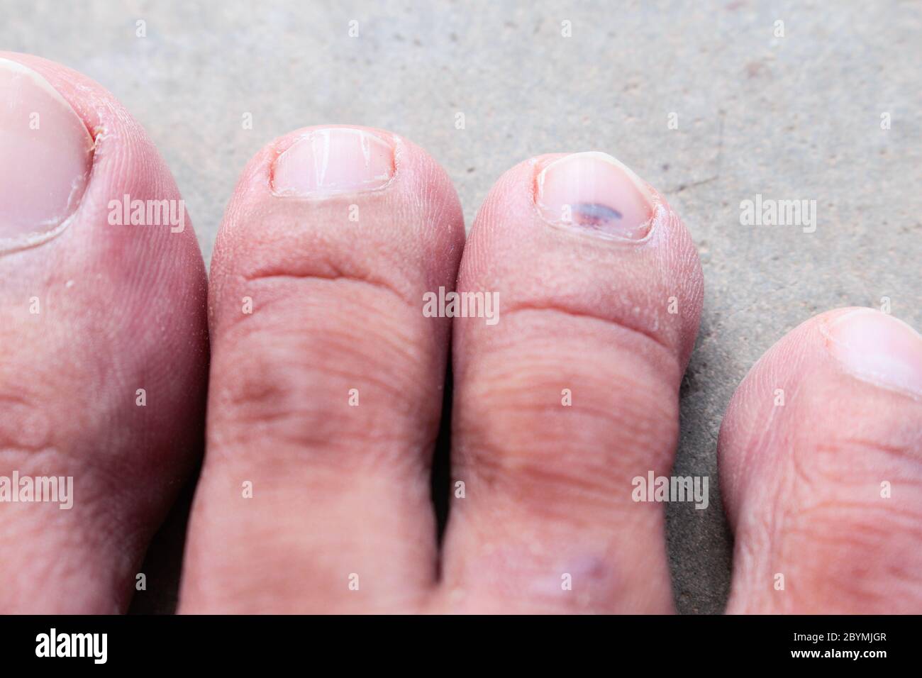 el hongo de psoriasis del pie de atleta de la piel de primer plano, el