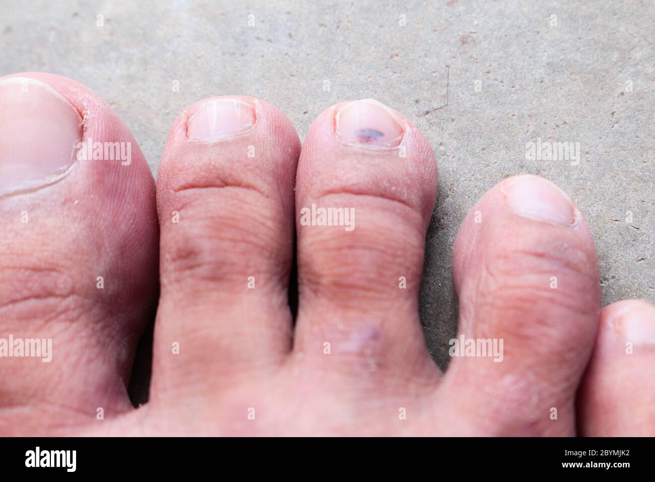 el hongo de psoriasis del pie de atleta de la piel de primer plano, el