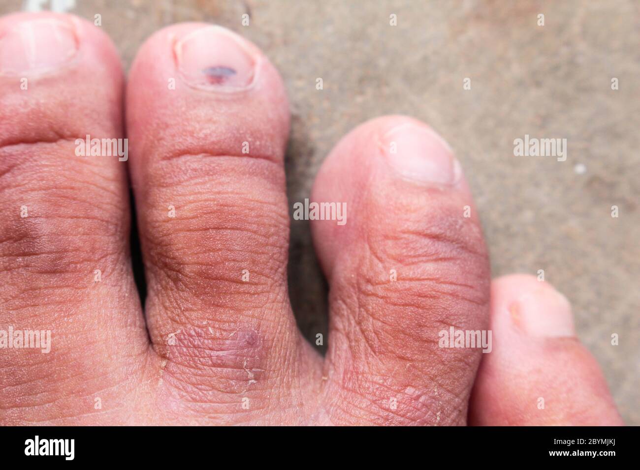 el hongo de psoriasis del pie de atleta de la piel de primer plano, el