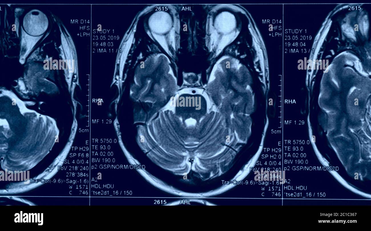 Imagen cerebral de un hombre joven, se ven los ojos Foto de stock