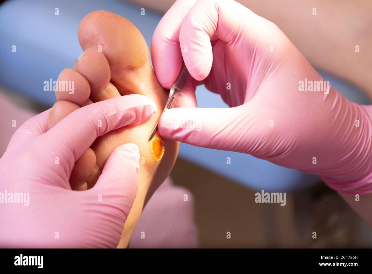 Las manos de un podólogo femenino irreconocible con guantes rosados  cortando el callo un pie con un escalpelo Fotografía de stock - Alamy