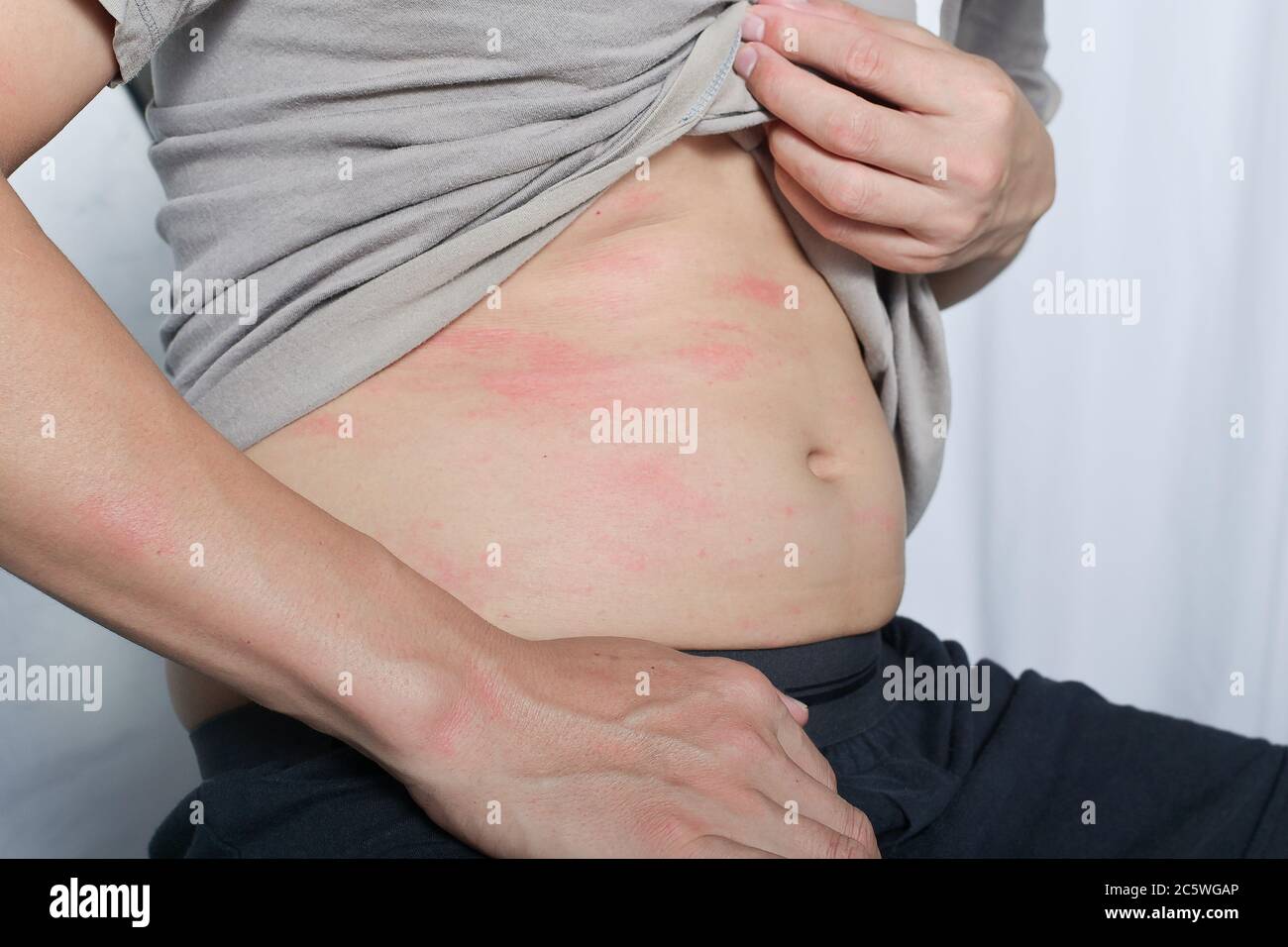 La alergia es una erupción roja en el cuerpo es una erupción causada por una oruga Foto de stock