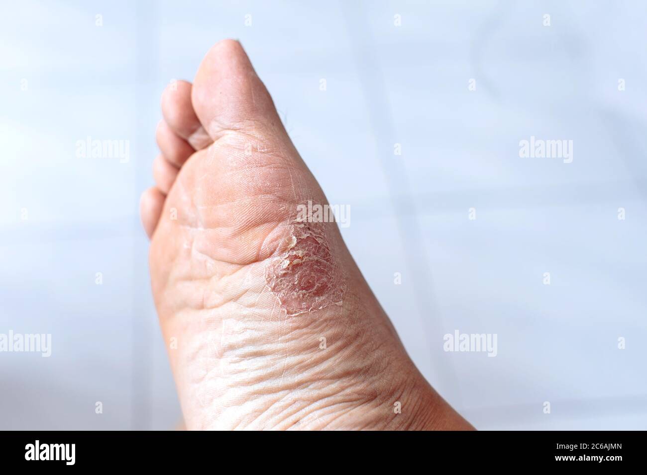 Primer plano de una enfermedad de pie de atleta. Es una infección