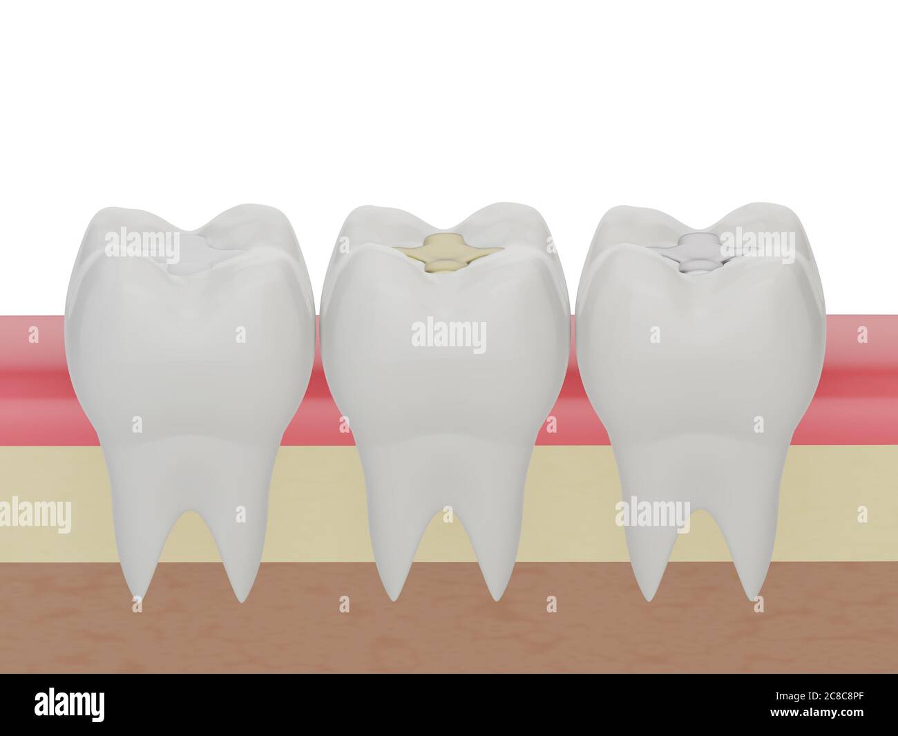 Dientes con relleno dental de incrustaciones de oro, amalgama y