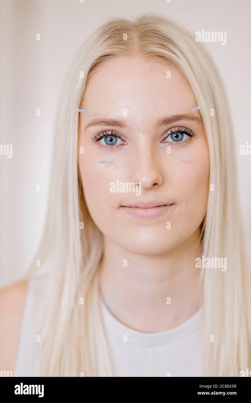 Acupuntura, mujer joven con agujas de acupuntura durante el tratamiento en  la cara Fotografía de stock - Alamy