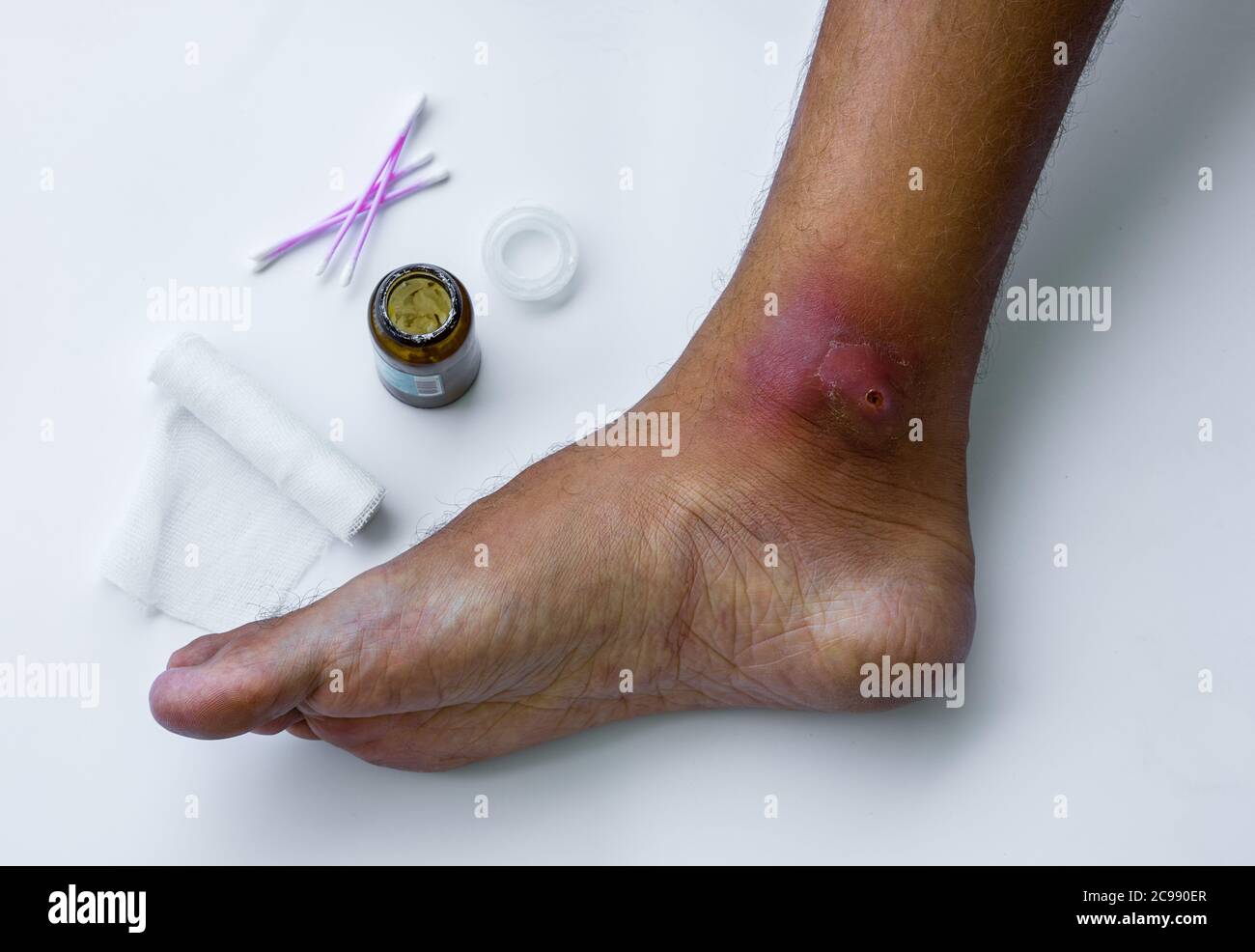 Los abscesos se forman después de las bacterias. Herida abierta purulenta infectada en el pie del hombre. Proceso de cuidado de heridas por enfullamiento. Foto de stock