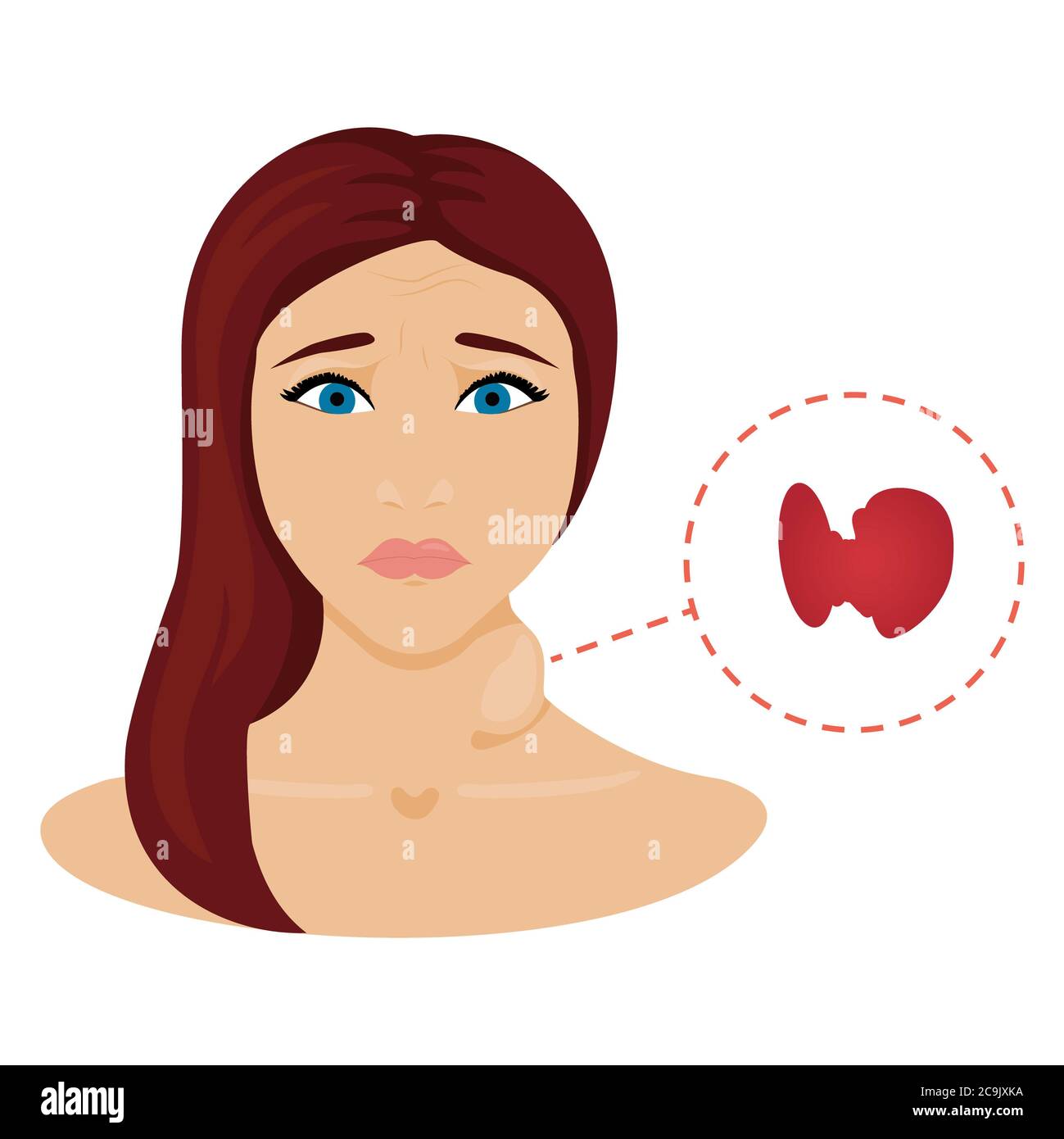 Hipertiroidismo ilustracion Imágenes recortadas de stock Alamy