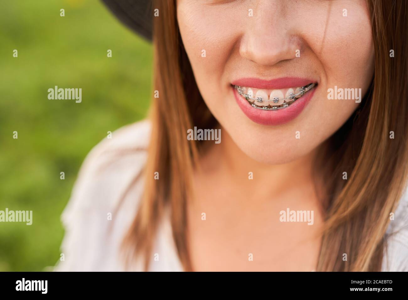 Cheerful Orthodontic Braces Beauty Dental Health Happiness Fotos E Imagenes De Stock Alamy