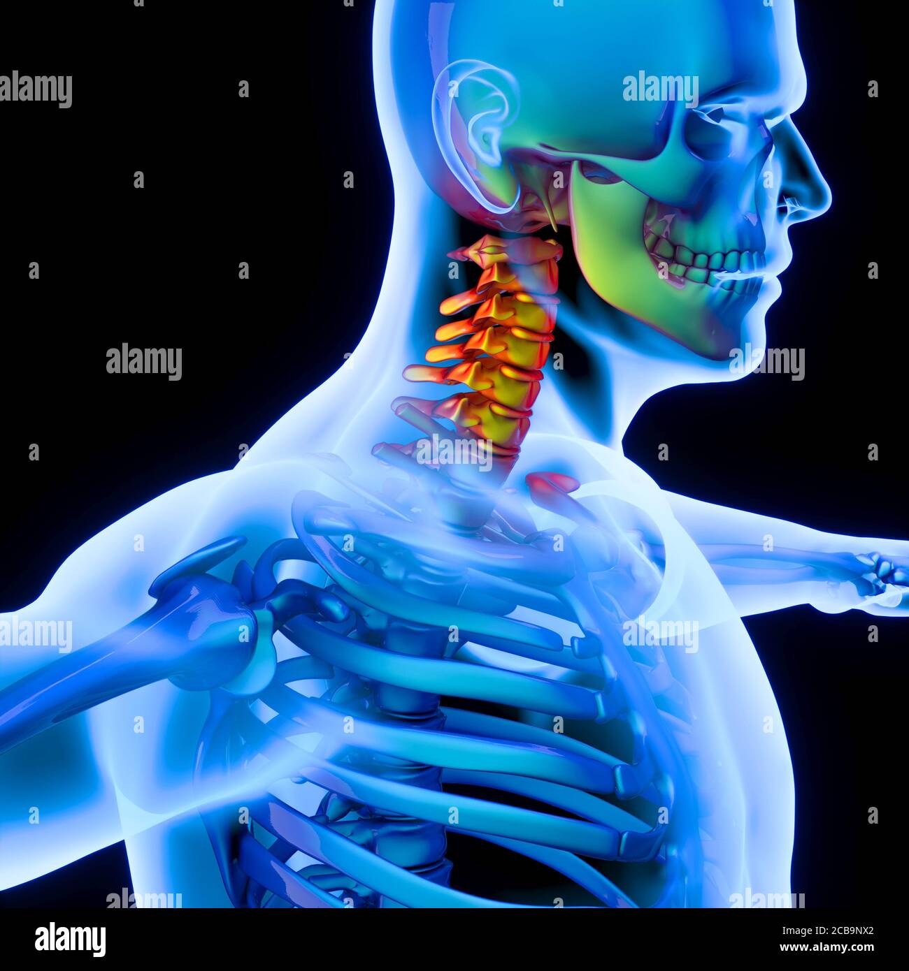 inflamación de la columna vertebral a las vértebras cervicales, cuello rígido. renderizar en 3d. Foto de stock
