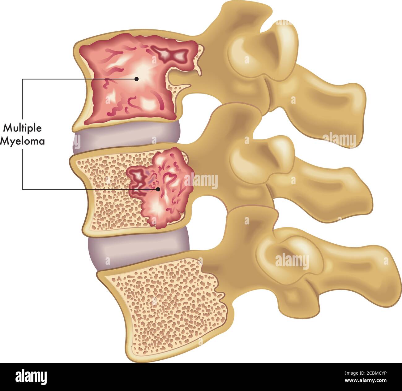 Ilustración médica de dos vértebras de la columna afectadas por el mieloma múltiple. Ilustración del Vector