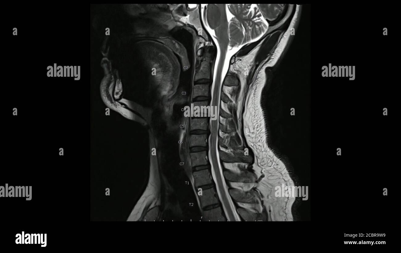 Imágenes de resonancia magnética de la columna cervical imágenes