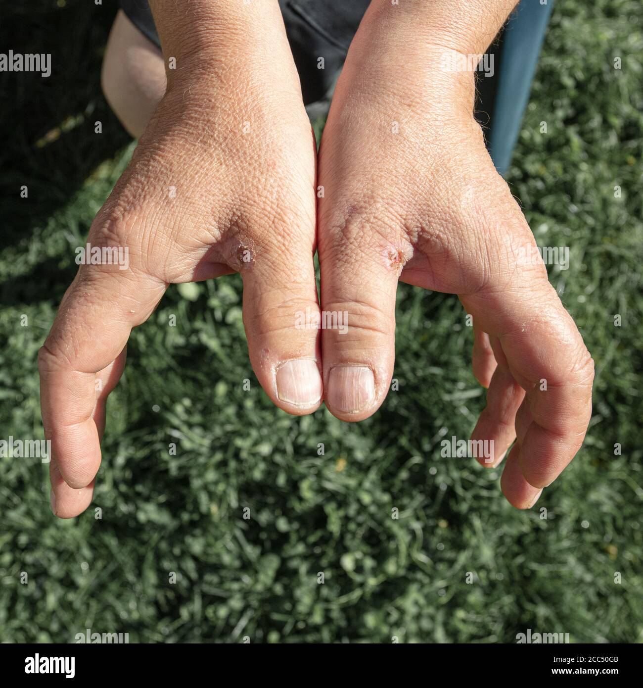 Callos en las manos, primer plano de las manos masculinas. Foto de alta  calidad Fotografía de stock - Alamy