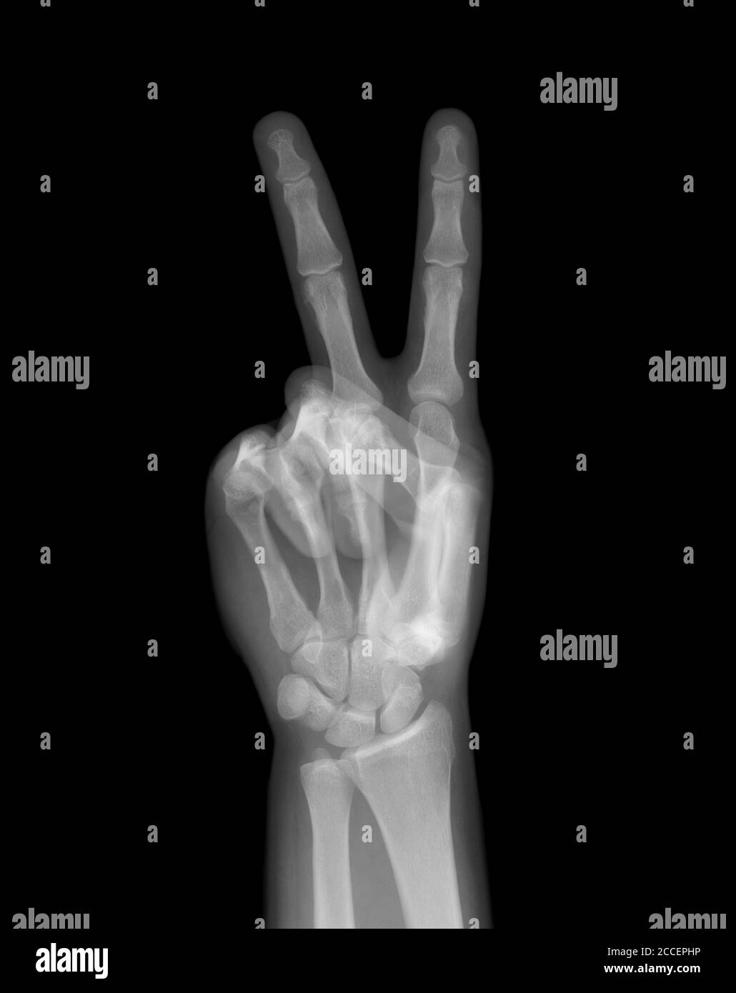 Gesto de mano de paz, rayos X. Foto de stock