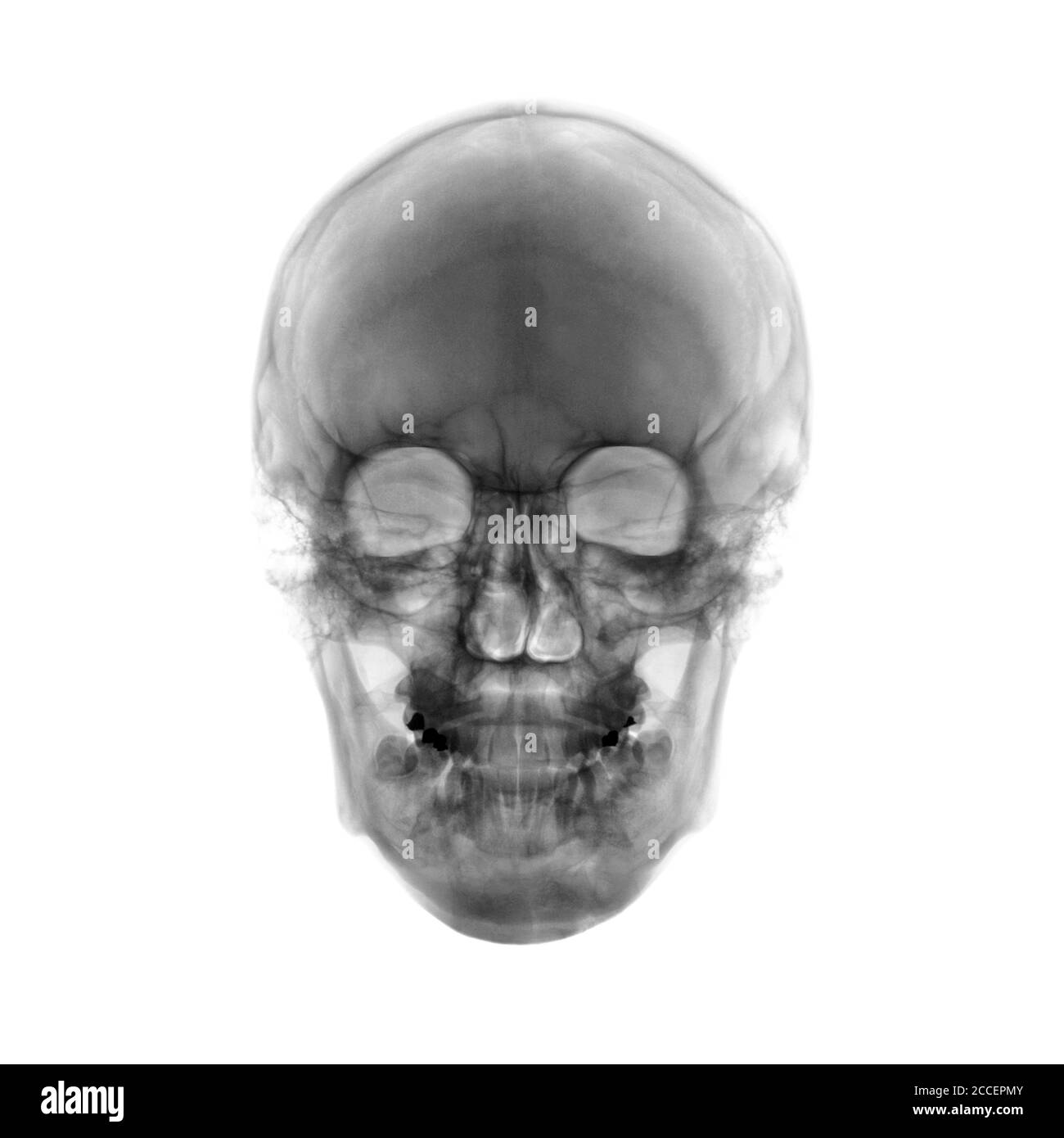 Cráneo humano, rayos X. Foto de stock