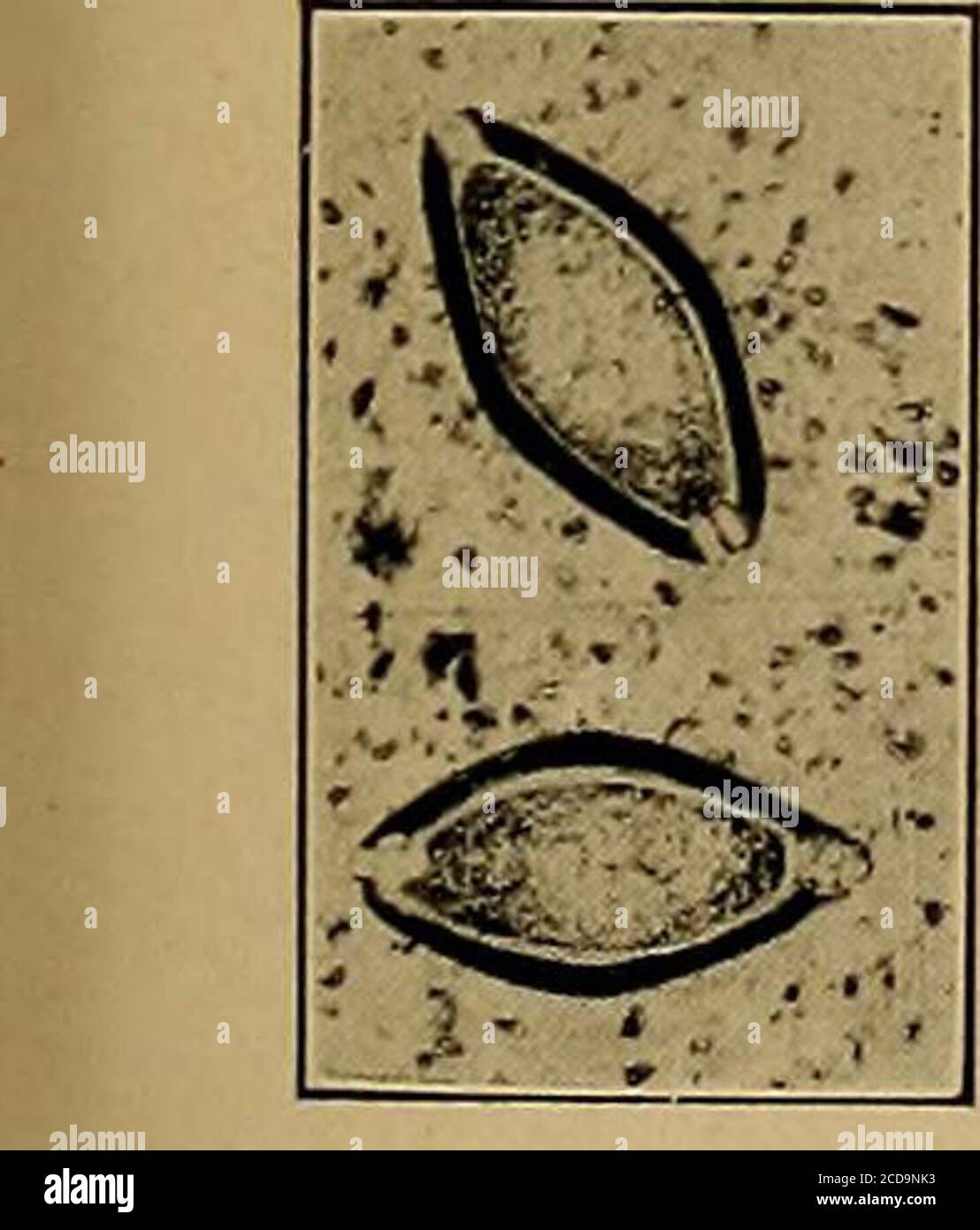 Diagnostico Fisico Uncinaria Americana Anchylostoma Duodenale Jcv J Q Z Ju M Pr Imm T I Bl Wa Gt I Yf I J V Y V Jpr Fotografia De Stock Alamy