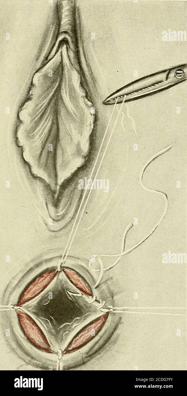 https://c8.alamy.com/compes/2cdg7fy/ginecologia-bordes-de-la-herida-suaves-y-uniformes-y-no-llevar-la-diseccion-demasiado-lejos-en-la-piel-clamp-y-cautery-en-nuestra-practica-el-metodo-de-clamp-y-cauterio-para-tratar-hemorroides-se-ha-dejado-en-favor-de-la-diseccion-y-ligadura-debido-a-la-mayor-frecuencia-de-fisura-postoperatoria-y-de-la-mayor-por-centage-de-recidiva-en-el-primer-metodo-la-operacion-es-la-siguiente-dilatacion-del-esfinter-con-el-paciente-en-la-posicion-perineal-la-hemorroide-mas-visible-es-incautada-por-una-arteria-de-operaciones-en-el-recto-823-forceps-en-su-punto-mas-saliente-y-levantado-2cdg7fy.jpg