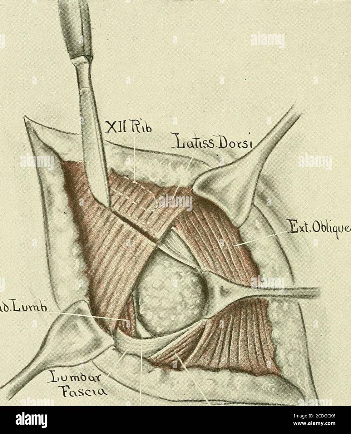 . Ginecología : . J.&lt;V)mWxIc?.ct.(. £x.0b)ic 0&lt; Fig. 458.—suspensión del riñón. Retracción del músculo dorsal ancho, exponiendo el trigonum lumbar superior. La fascia lumbar ha sido perforada, permitiendo que la grasa retroperitoneal se extruya a través de la abertura. Los músculos oblicuos, cuyas fibras se encuentran entre sí en un ligero ángulo. En el borde inferior de la herida retraída, los músculos se desvían, dejando un pequeño espacio de la fascia GINECOLÓGICA triangular 798, el llamado triángulo de los Petits; directamente enfrente de este triángulo, en el borde superior de la herida, se puede sentir la punta de la duodécima costilla (Fig. 457 Foto de stock
