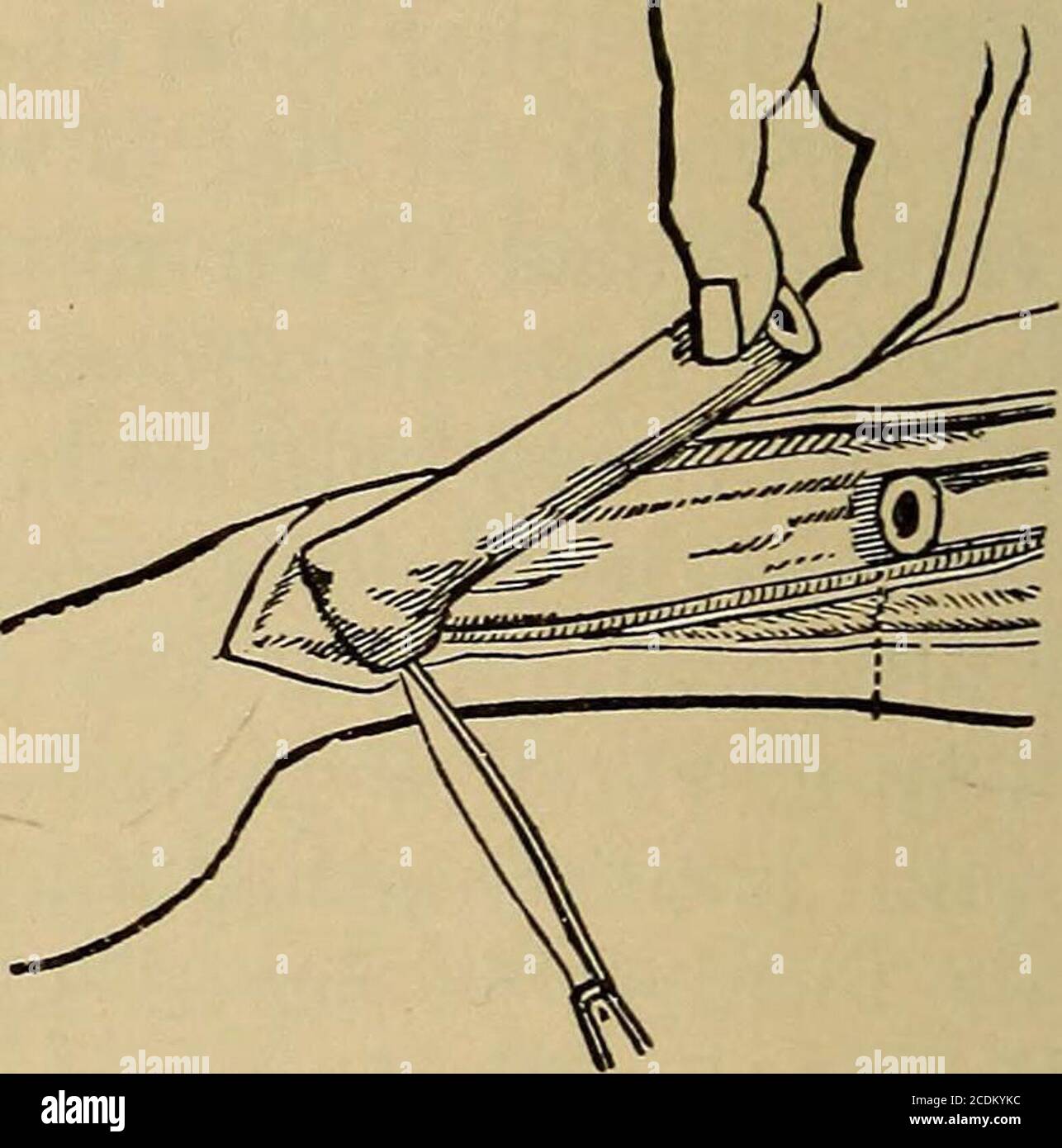 Cirugía menor y quirúrgica, incluyendo vendaje. Se usa para evitar lesiones  de la arteria y vena braquial y del nervio mediano. Resección del radio o  ulna.—el radio orulna puede resecarse, total