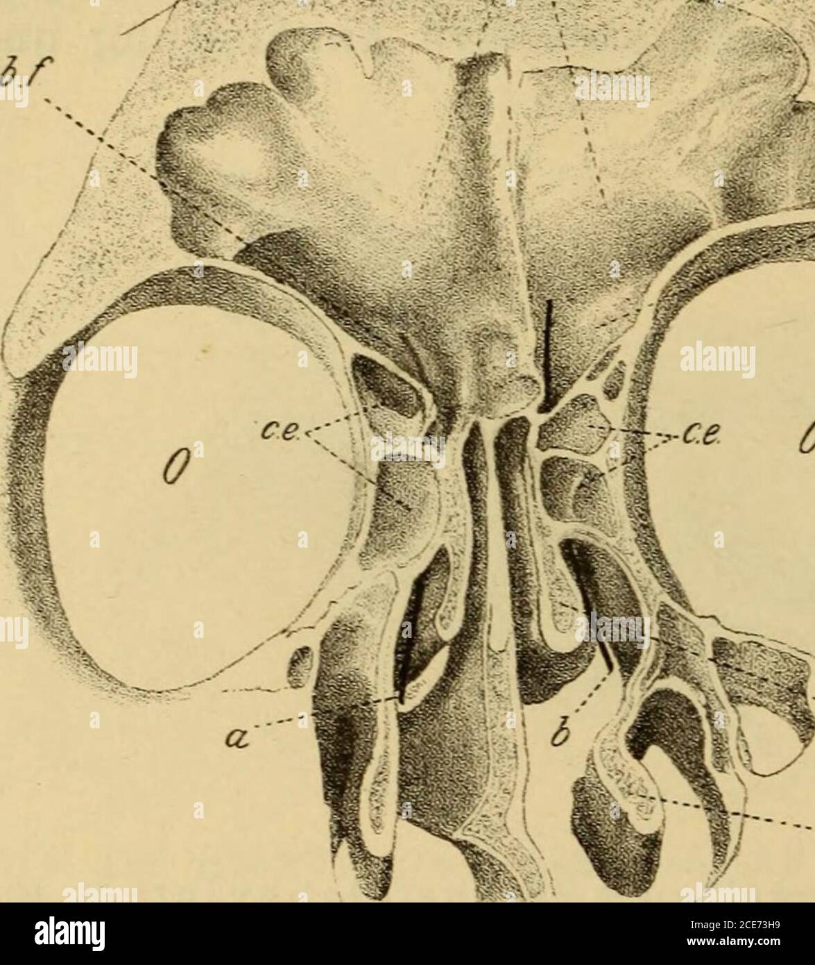 Patologie und Therapie der entzündlichen Erkrankungen der Nebenhöhlen der  Nase . En einzelnen Fällen bildet dieselbe eine solide, dünne  Knochen-platte, welche bald inniger un die vordere Partie des  infundíbulumsich anschliesst, bald