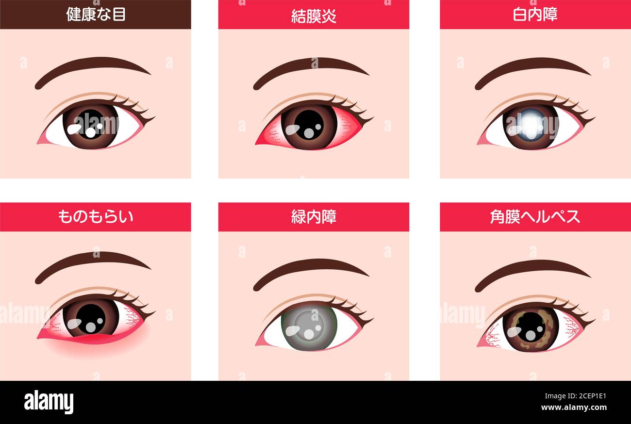 Varias enfermedades oculares ilustración vectorial ( ojo femenino Imagen  Vector de stock - Alamy