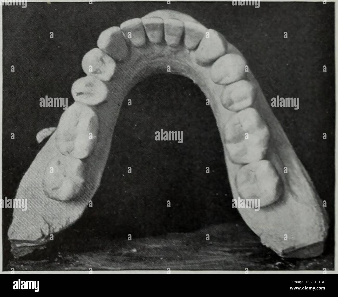 El cosmos Dental. Mostrando la vista posterior del espacio nasal, la masa  lateral derecha dividida en células posteriores de la etis moidal, y la  masa lateral izquierda no dividida. Espolón septal,