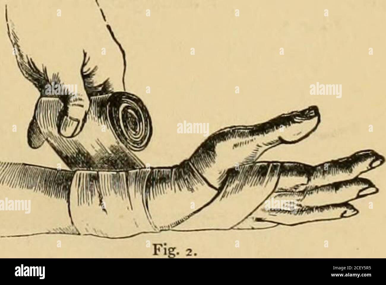 una cyclopædia nacional de información práctica  Fig. I. aumentos en el  tamaño el vendaje debe girar solo después de la manera del tlie  representada en las Figs. 3 y IV