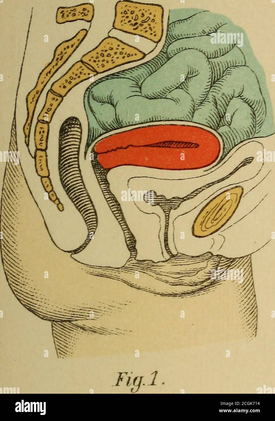 Atlas Y Epitome De Ginecologia Miomata Y 3 3 Y 4 El Tratamiento Sintomatologico Es El De La Catarrh Uterina Ver Endometritis El Dolor Ver Parametritis Y 4 8 La Distursion